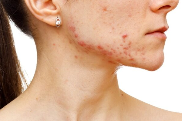 tratamento para acne no rio de janeiro