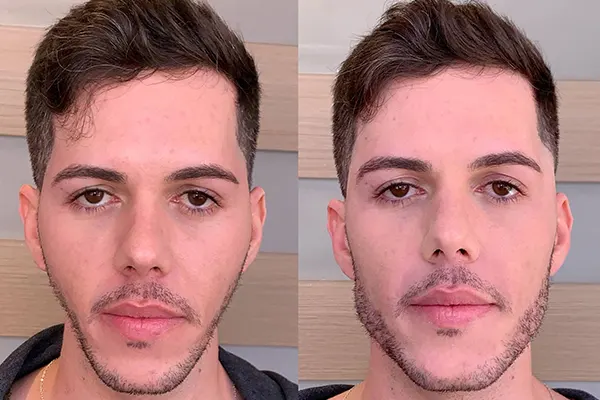 haronização facial antes e depois