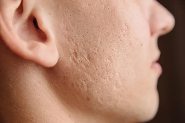 tratamento para cicatrizes de acne
