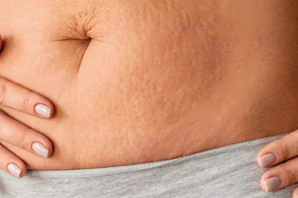 tratamento para flacidez corporal