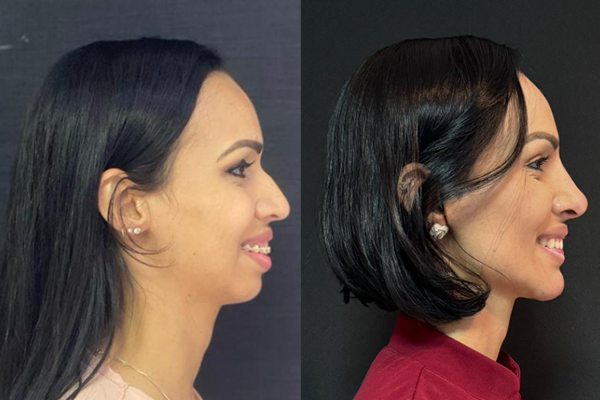preenchimento do queixo antes e depois