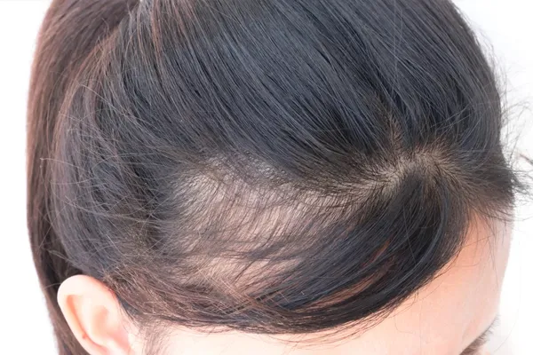 alopecia fronta fibrosante sinais iniciais