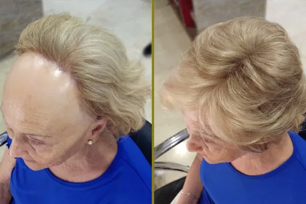 alopecia frontal fibrosante