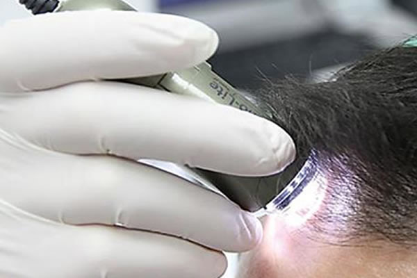 Mão com luva conduzindo um dermatoscópio para avaliação do couro cabeludo por tricoscopia